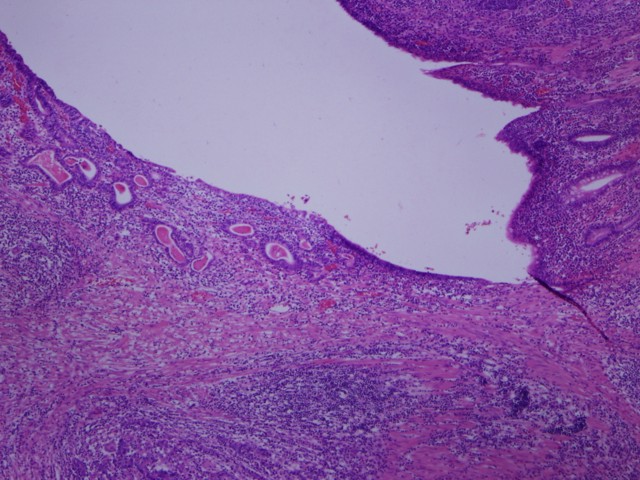 Figura 5. Zona de ulceracin con aisladas estructuras glanduliformes tumorales en el lecho